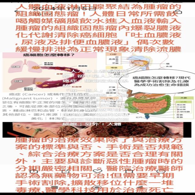 人人身上都有癌細胞,卻不是人人都得癌症:關鍵在免疫系統 「每一個人」身上都會出現癌細胞。人體內細胞不斷複製增加,染色體複製的過程中,基因就可能發生突變,突變的累積會使正常細胞變成癌細胞;另外,人體外的幽門螺旋桿菌、B 型肝炎病毒、陽光中的紫外線、食物中的亞硝胺等,也都有機會促進細胞突變。 人體產生癌細胞手術